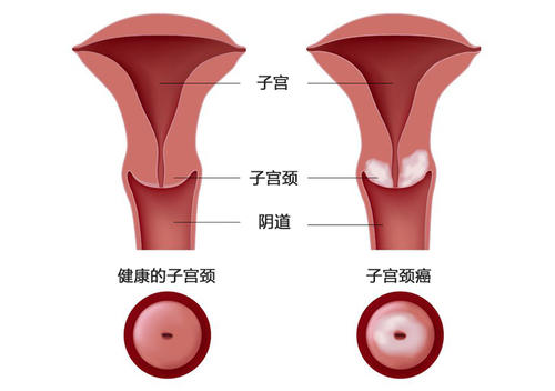 毕节妇女患宫颈癌的前兆有哪些