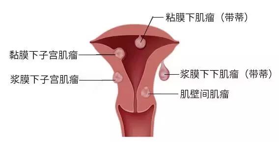 毕节妇女子宫肌瘤11厘米怎么办
