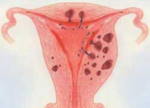 毕节女性子宫肌瘤软和硬的区别