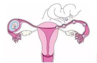 毕节女性子宫内膜异位的危害