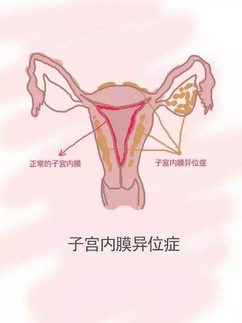 毕节妇女子宫内膜异位是怎么引起的