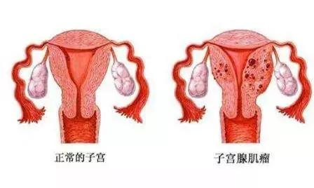 毕节妇女子宫肌瘤是因为宫寒吗