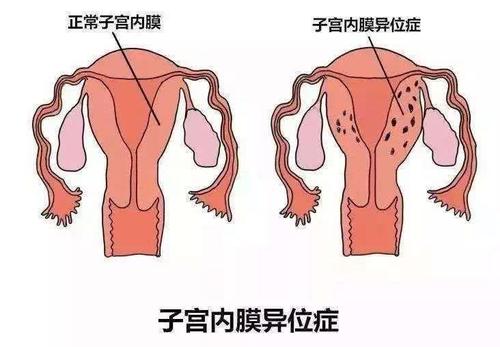 毕节妇女子宫内膜异位检查是怎样的