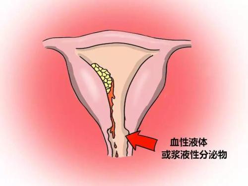 毕节妇女宫颈息肉一般多久复发